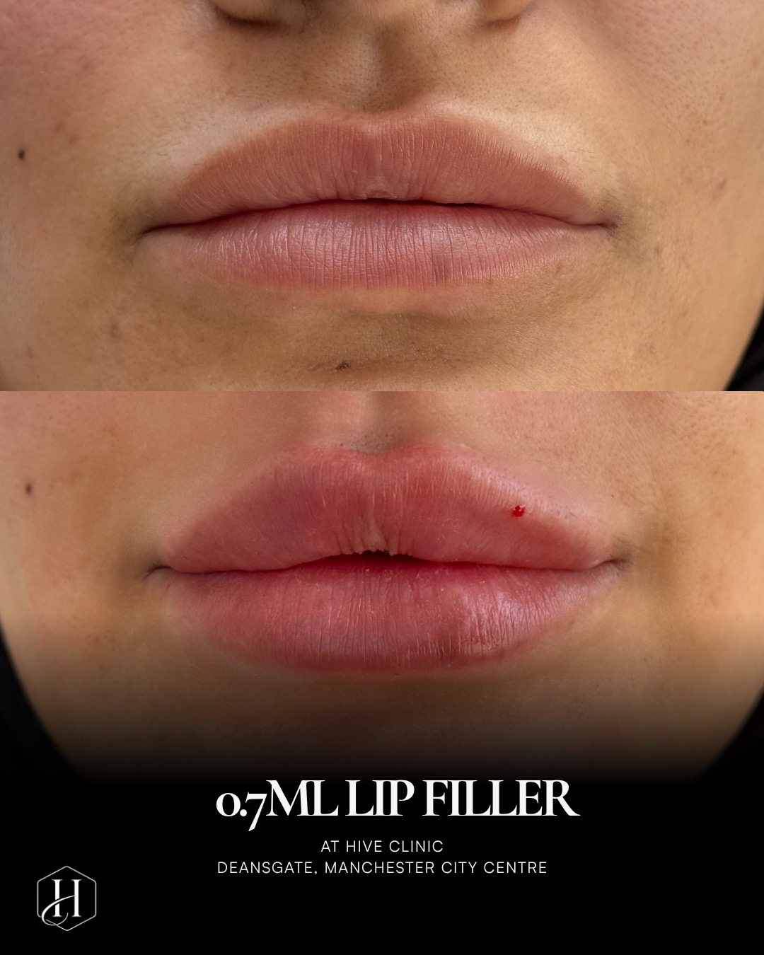 Lip Enhancement
