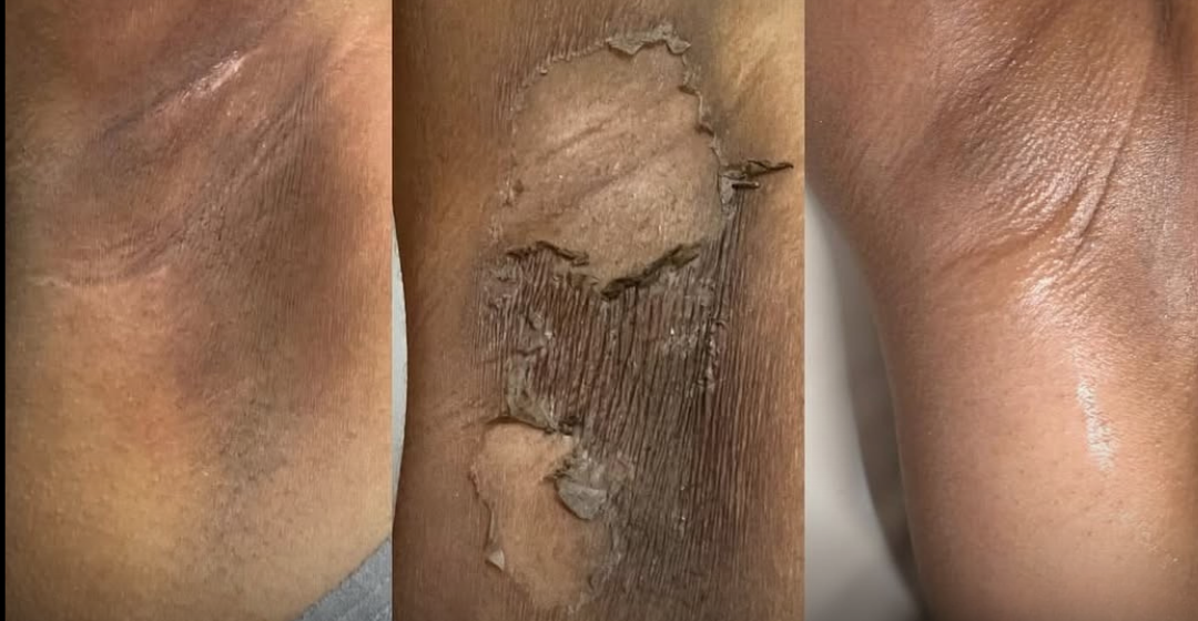 Ultimate Underarm Brightening Programme