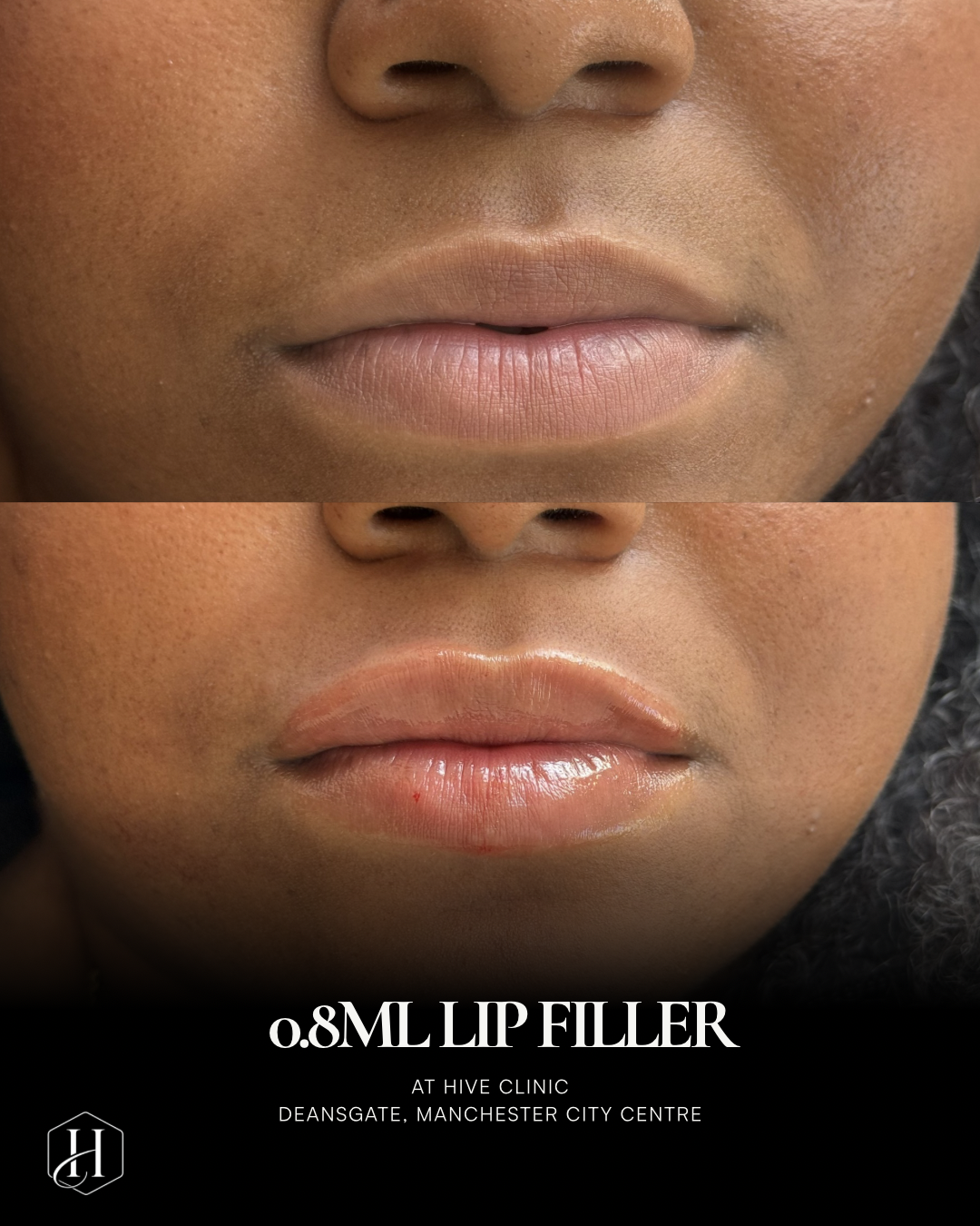 Lip Filler