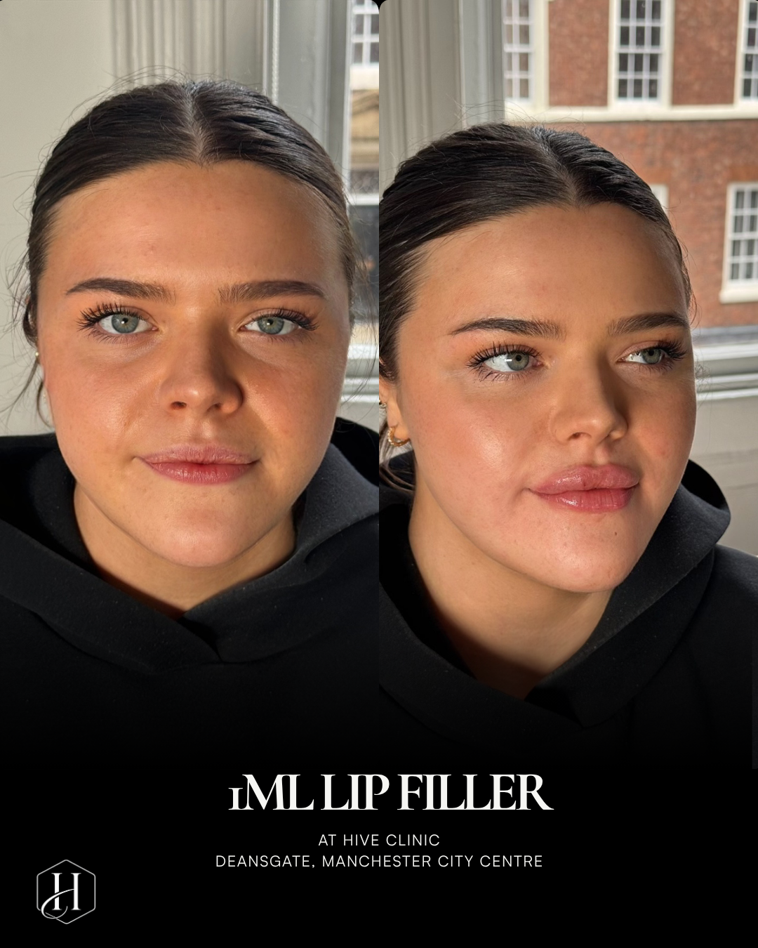 1ml Lip Filler